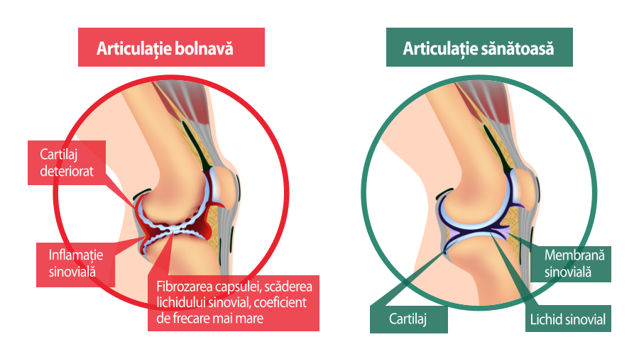osteochondroza durere blocantă hepatoza genunchiului tratament de 3 grade